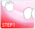 インプラントの治療の流れSTEP1