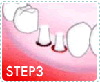 インプラントの治療の流れSTEP3