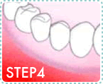 インプラントの治療の流れSTEP4