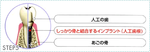 インプラントの治療の流れSTEP5