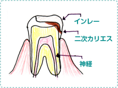 歯の画像