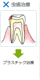 ×虫歯治療