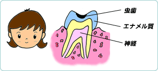 虫歯の進行C1
