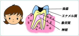 虫歯の進行C2