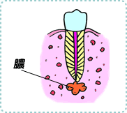 根尖性歯周炎の治療1