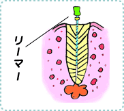 根尖性歯周炎の治療2