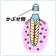 根尖性歯周炎の治療5