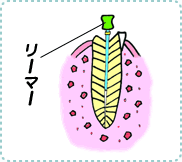 歯髄炎の治療3