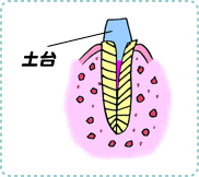 歯髄炎の治療5